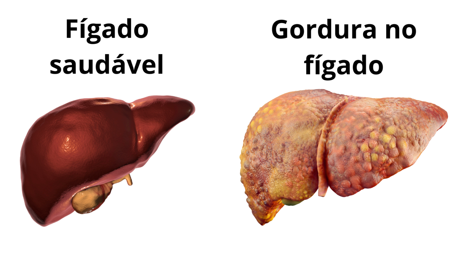 Gordura no Fígado: Preciso me Preocupar? - Dr. Matheus Vanzin Fernandes