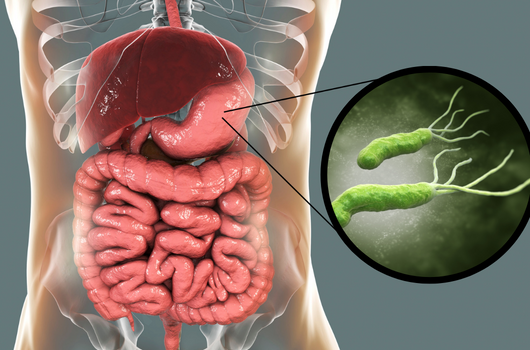 Helicobacter pylori